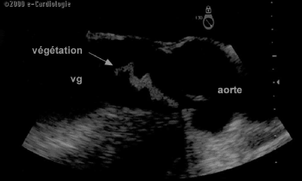 endocarditeaortiqueeto