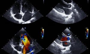 Dysfonction de prothèse valvulaire : quelle imagerie utiliser ?