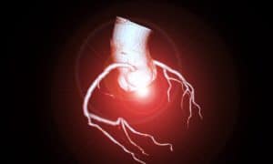 Ischémie myocardique